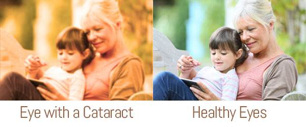 Eye with a Cataract vs. Healthy Eyes 