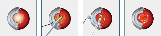 Cataract Surgery Procedure