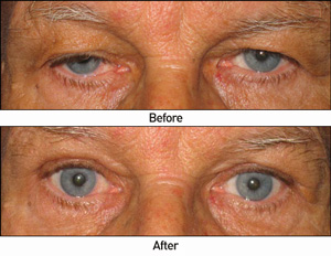 Ptosis Repair Before and After