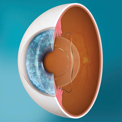 Mins Lens for Double Vision — The Low Vision Centers of Indiana